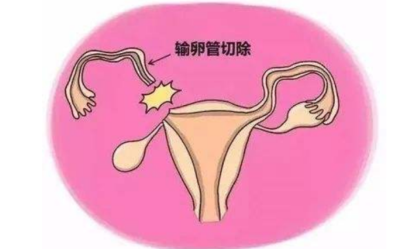 女性結扎最新方法